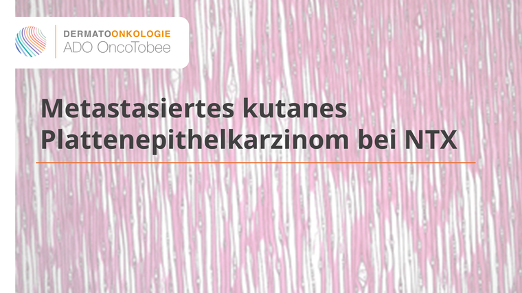 metastasiertes kutanes plattenepithelkarzinom bei ntx titelbild