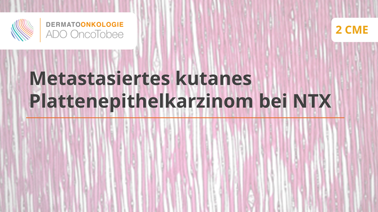 metastasiertes kutanes plattenepithelkarzinom bei ntx titelbild